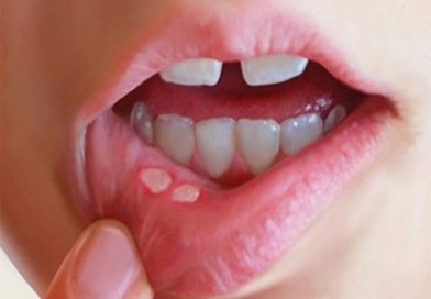 زخمهای دردناک دهان از کجا میآیند؟/ دلایل شایع و راههای کاهش درد و پیشگیری زخمهای دردناک دهان از کجا میآیند؟/ دلایل شایع و راههای کاهش درد و پیشگیری